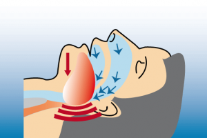 Further falling back of the tongue can lead to a complete occlusion of the airway resulting in respiratory misfire.